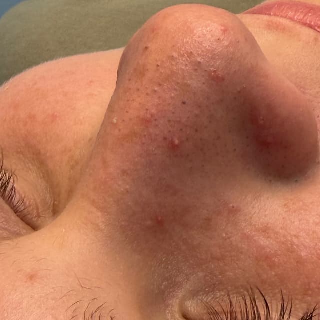 Back to school facial at Femme Aesthetic in Chula Vista, CA